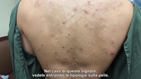 punti neri sulla schiena punti neri sulla schiena