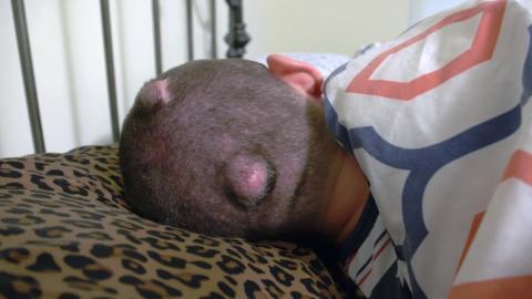 es peligroso un lipoma en la cabeza