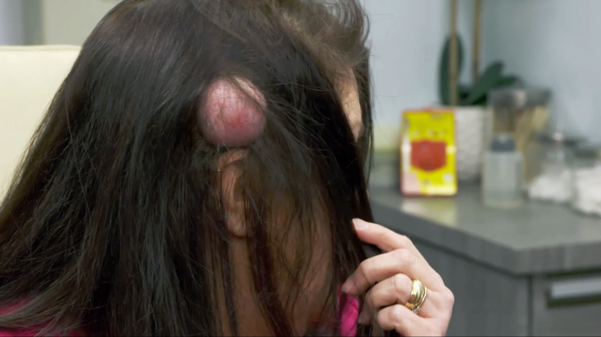 Bulto en la cabeza dolor
