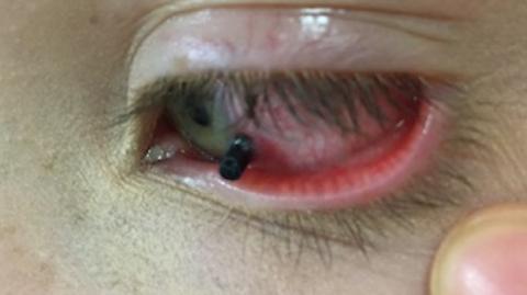 infección del ojo azul jay